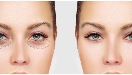 How To Reduce Dark Circles And Puffy Eyes Naturally